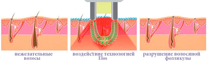 Как работает элос эпилятор - схема эпиляции током