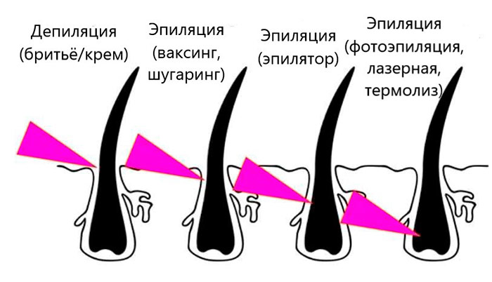 Эпиляция и депиляция - отличия методов удаления волос